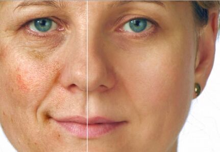 Результат омоложения